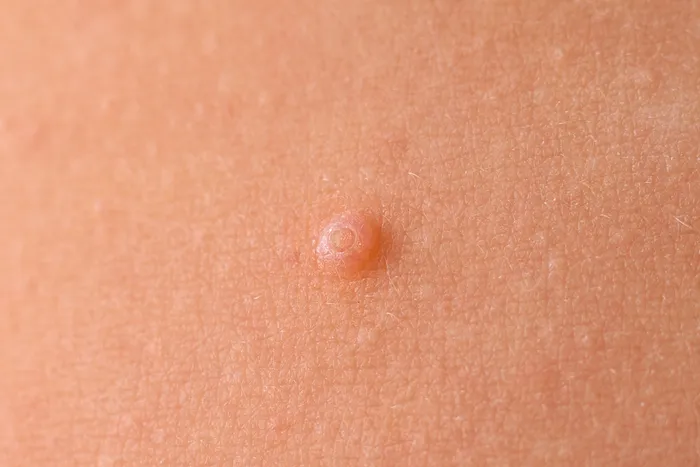 Close-up of individual molluscum contagiosum